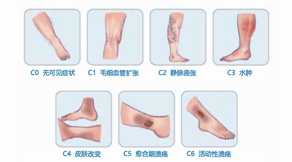 互聯(lián)網(wǎng)洞察助力規(guī)范診療，讓1.2億患者夏天不懼“蚯蚓腿”